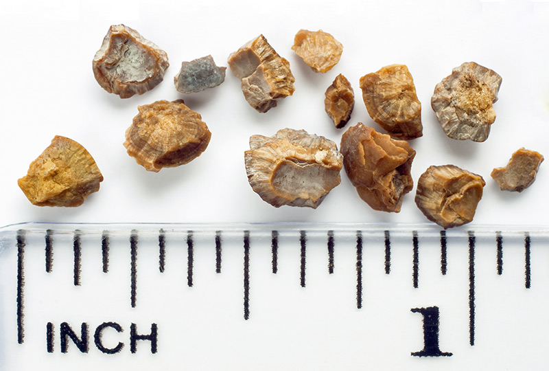 Kidney stones South